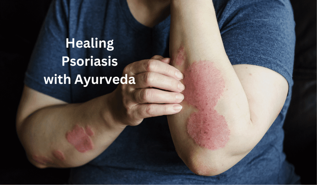 Explore Ayurveda and Yoga through expert articles. Psoriasis Ayurvedic Treatment Kerala